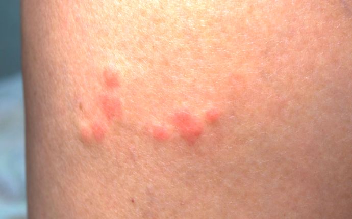 Close-up of bed bug bites.